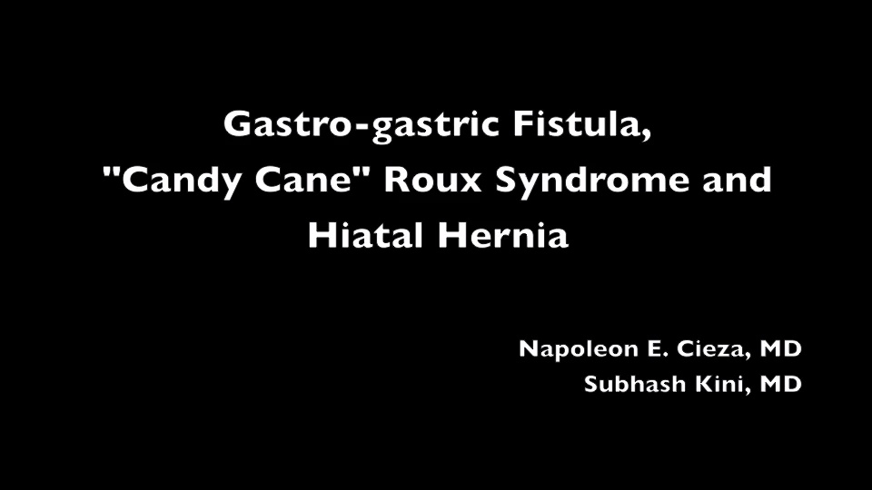 GastroGastric Fistula Candy Cane Roux Syndrome and Hiatal Hernia