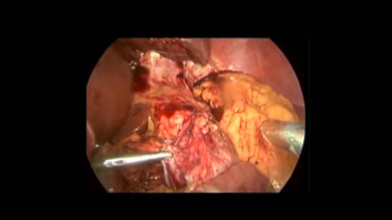 Stapling of gastric tube during gastrojejunal anastomosis an unusual ...