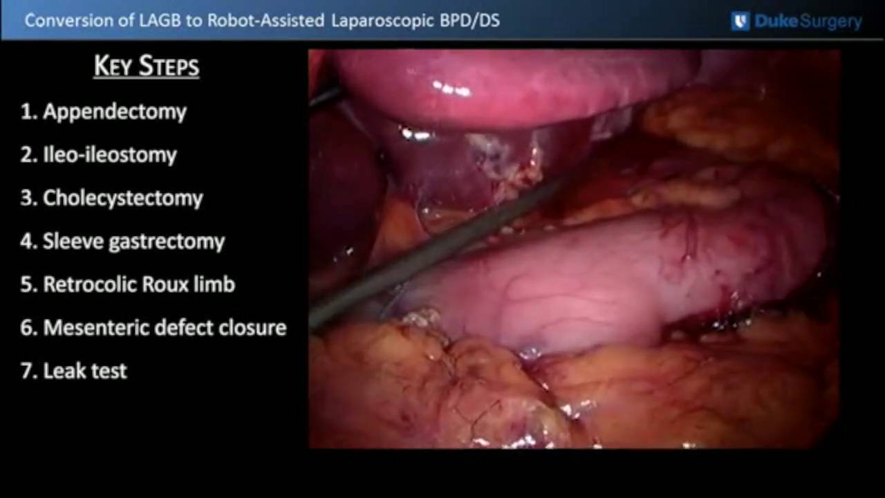 Conversion of laparoscopic adjustable gastric band to robotassisted